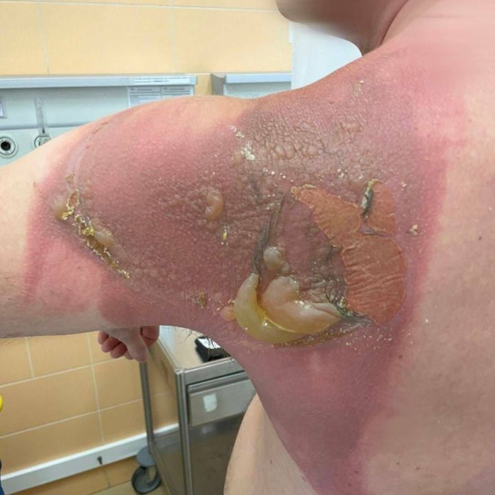 Житель Татарстана получил химический ожог от постельного белья, постиранного иностранными капсулами